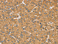 The image on the left is immunohistochemistry of paraffin-embedded Human liver cancer tissue using CSB-PA787739(LMO4 Antibody) at dilution 1/20, on the right is treated with fusion protein. (Original magnification: ×200)