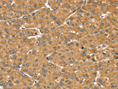 The image on the left is immunohistochemistry of paraffin-embedded Human liver cancer tissue using CSB-PA787739(LMO4 Antibody) at dilution 1/20, on the right is treated with fusion protein. (Original magnification: ×200)