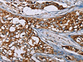The image on the left is immunohistochemistry of paraffin-embedded Human breast cancer tissue using CSB-PA787876(BMP6 Antibody) at dilution 1/50, on the right is treated with synthetic peptide. (Original magnification: ×200)