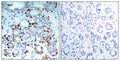 Immunohistochemical analysis of paraffin-embedded human breast carcinoma tissue using BIM(Phospho-Ser69) Antibody(left) or the same antibody preincubated with blocking peptide(right).