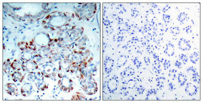 Immunohistochemical analysis of paraffin-embedded human breast carcinoma tissue using BIM(Phospho-Ser69) Antibody(left) or the same antibody preincubated with blocking peptide(right).