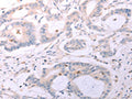 The image on the left is immunohistochemistry of paraffin-embedded Human colon cancer tissue using CSB-PA787914(ACOT2 Antibody) at dilution 1/25, on the right is treated with fusion protein. (Original magnification: ×200)