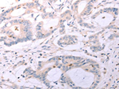 The image on the left is immunohistochemistry of paraffin-embedded Human colon cancer tissue using CSB-PA787914(ACOT2 Antibody) at dilution 1/25, on the right is treated with fusion protein. (Original magnification: ×200)