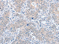 The image on the left is immunohistochemistry of paraffin-embedded Human gastic cancer tissue using CSB-PA787971(PARD6A Antibody) at dilution 1/60, on the right is treated with fusion protein. (Original magnification: ×200)