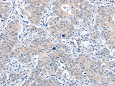 The image on the left is immunohistochemistry of paraffin-embedded Human gastic cancer tissue using CSB-PA787971(PARD6A Antibody) at dilution 1/60, on the right is treated with fusion protein. (Original magnification: ×200)