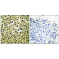 Immunohistochemical analysis of paraffin-embedded human breast carcinoma tissue using MCL1 antibody.