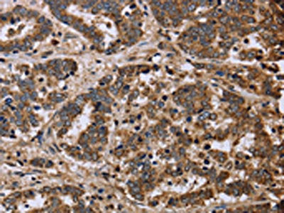 The image on the left is immunohistochemistry of paraffin-embedded Human liver cancer tissue using CSB-PA788032(FH Antibody) at dilution 1/40, on the right is treated with fusion protein. (Original magnification: ×200)