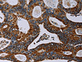 The image on the left is immunohistochemistry of paraffin-embedded Human colon cancer tissue using CSB-PA788069(NDUFA4 Antibody) at dilution 1/40, on the right is treated with synthetic peptide. (Original magnification: ×200)