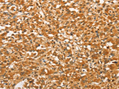 The image on the left is immunohistochemistry of paraffin-embedded Human thyroid cancer tissue using CSB-PA788468(BCL2L14 Antibody) at dilution 1/40, on the right is treated with fusion protein. (Original magnification: ×200)