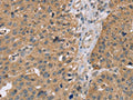 The image on the left is immunohistochemistry of paraffin-embedded Human breast cancer tissue using CSB-PA788709(RNF139 Antibody) at dilution 1/35, on the right is treated with synthetic peptide. (Original magnification: ×200)