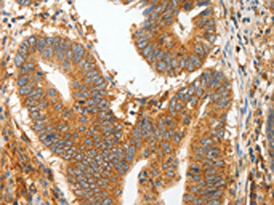 The image on the left is immunohistochemistry of paraffin-embedded Human colon cancer tissue using CSB-PA789328(MMP28 Antibody) at dilution 1/20, on the right is treated with fusion protein. (Original magnification: ×200)