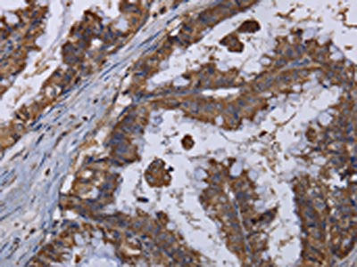 The image on the left is immunohistochemistry of paraffin-embedded Human esophagus cancer tissue using CSB-PA789465(MT3 Antibody) at dilution 1/50, on the right is treated with fusion protein. (Original magnification: ×200)