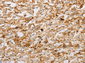 The image on the left is immunohistochemistry of paraffin-embedded Human thyroid cancer tissue using CSB-PA790002(S100A1 Antibody) at dilution 1/20, on the right is treated with fusion protein. (Original magnification: ×200)