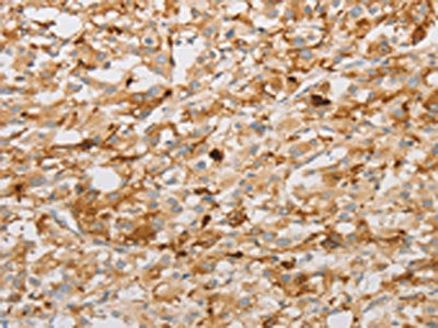 The image on the left is immunohistochemistry of paraffin-embedded Human thyroid cancer tissue using CSB-PA790002(S100A1 Antibody) at dilution 1/20, on the right is treated with fusion protein. (Original magnification: ×200)