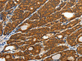 The image on the left is immunohistochemistry of paraffin-embedded Human thyroid cancer tissue using CSB-PA790121(CRP Antibody) at dilution 1/40, on the right is treated with fusion protein. (Original magnification: ×200)