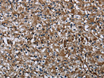 The image on the left is immunohistochemistry of paraffin-embedded Human prostate cancer tissue using CSB-PA790157(FAM89B Antibody) at dilution 1/20, on the right is treated with fusion protein. (Original magnification: ×200)