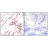 Immunohistochemistry analysis of paraffin-embedded human lung carcinoma tissue using p300 antibody.