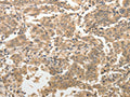 The image on the left is immunohistochemistry of paraffin-embedded Human gastic cancer tissue using CSB-PA790607(ADAR Antibody) at dilution 1/40, on the right is treated with synthetic peptide. (Original magnification: ×200)