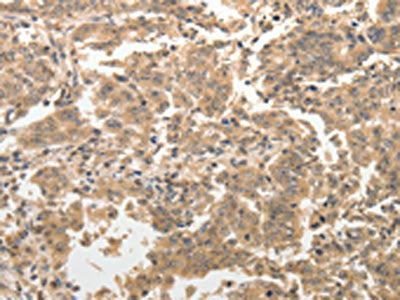 The image on the left is immunohistochemistry of paraffin-embedded Human gastic cancer tissue using CSB-PA790607(ADAR Antibody) at dilution 1/40, on the right is treated with synthetic peptide. (Original magnification: ×200)