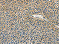 The image on the left is immunohistochemistry of paraffin-embedded Human liver cancer tissue using CSB-PA790667(ASPA Antibody) at dilution 1/80, on the right is treated with fusion protein. (Original magnification: ×200)