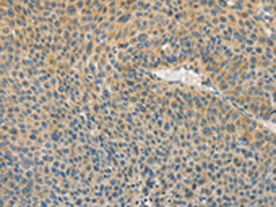 The image on the left is immunohistochemistry of paraffin-embedded Human liver cancer tissue using CSB-PA790667(ASPA Antibody) at dilution 1/80, on the right is treated with fusion protein. (Original magnification: ×200)