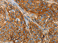 The image on the left is immunohistochemistry of paraffin-embedded Human esophagus cancer tissue using CSB-PA791042(B2M Antibody) at dilution 1/25, on the right is treated with fusion protein. (Original magnification: ×200)