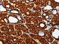 The image on the left is immunohistochemistry of paraffin-embedded Human thyroid cancer tissue using CSB-PA791069(TXN Antibody) at dilution 1/40, on the right is treated with synthetic peptide. (Original magnification: ×200)