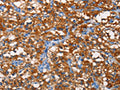 The image on the left is immunohistochemistry of paraffin-embedded Human thyroid cancer tissue using CSB-PA791074(PFKP Antibody) at dilution 1/25, on the right is treated with fusion protein. (Original magnification: ×200)