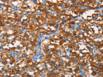 The image on the left is immunohistochemistry of paraffin-embedded Human thyroid cancer tissue using CSB-PA791074(PFKP Antibody) at dilution 1/25, on the right is treated with fusion protein. (Original magnification: ×200)