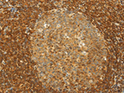 The image on the left is immunohistochemistry of paraffin-embedded Human tonsil tissue using CSB-PA791171(SLC6A3 Antibody) at dilution 1/20, on the right is treated with synthetic peptide. (Original magnification: ×200)