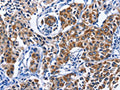The image on the left is immunohistochemistry of paraffin-embedded Human lung cancer tissue using CSB-PA791340(MYH1 Antibody) at dilution 1/40, on the right is treated with fusion protein. (Original magnification: ×200)