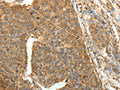 The image on the left is immunohistochemistry of paraffin-embedded Human liver cancer tissue using CSB-PA792120(PTCH1 Antibody) at dilution 1/40, on the right is treated with fusion protein. (Original magnification: ×200)