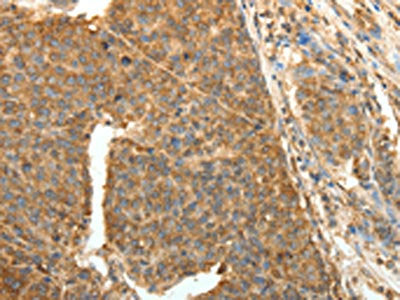 The image on the left is immunohistochemistry of paraffin-embedded Human liver cancer tissue using CSB-PA792120(PTCH1 Antibody) at dilution 1/40, on the right is treated with fusion protein. (Original magnification: ×200)