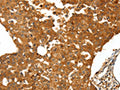 The image on the left is immunohistochemistry of paraffin-embedded Human breast cancer tissue using CSB-PA793008(SSTR1 Antibody) at dilution 1/50, on the right is treated with synthetic peptide. (Original magnification: ×200)