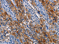 The image on the left is immunohistochemistry of paraffin-embedded Human lung cancer tissue using CSB-PA793095(ICAM1 Antibody) at dilution 1/40, on the right is treated with synthetic peptide. (Original magnification: ×200)