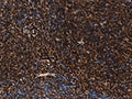 The image on the left is immunohistochemistry of paraffin-embedded Human tonsil tissue using CSB-PA793156(LMNB1 Antibody) at dilution 1/60, on the right is treated with fusion protein. (Original magnification: ×200)