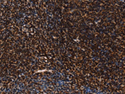 The image on the left is immunohistochemistry of paraffin-embedded Human tonsil tissue using CSB-PA793156(LMNB1 Antibody) at dilution 1/60, on the right is treated with fusion protein. (Original magnification: ×200)