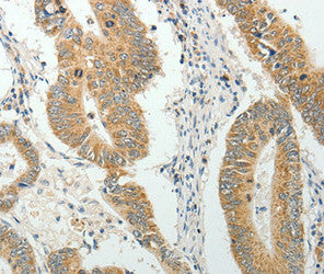 Immunohistochemical analysis of paraffin-embedded Human colon cancer tissue using at dilution 1/40.