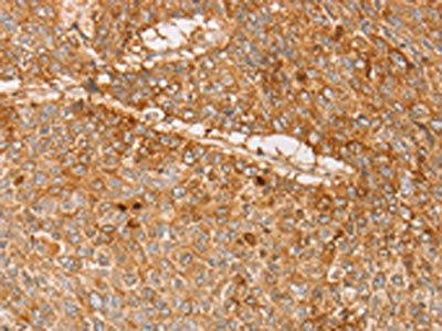 The image on the left is immunohistochemistry of paraffin-embedded Human lung cancer tissue using CSB-PA793216(PACSIN2 Antibody) at dilution 1/20, on the right is treated with fusion protein. (Original magnification: ×200)