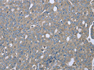 The image on the left is immunohistochemistry of paraffin-embedded Human ovarian cancer tissue using CSB-PA793275(EZR Antibody) at dilution 1/20, on the right is treated with fusion protein. (Original magnification: ×200)