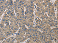 The image on the left is immunohistochemistry of paraffin-embedded Human liver cancer tissue using CSB-PA793788(IRAK4 Antibody) at dilution 1/40, on the right is treated with fusion protein. (Original magnification: ×200)