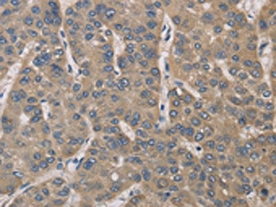 The image on the left is immunohistochemistry of paraffin-embedded Human liver cancer tissue using CSB-PA793788(IRAK4 Antibody) at dilution 1/40, on the right is treated with fusion protein. (Original magnification: ×200)