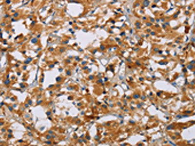 The image on the left is immunohistochemistry of paraffin-embedded Human thyroid cancer tissue using CSB-PA793884(NRN1 Antibody) at dilution 1/40, on the right is treated with fusion protein. (Original magnification: ×200)