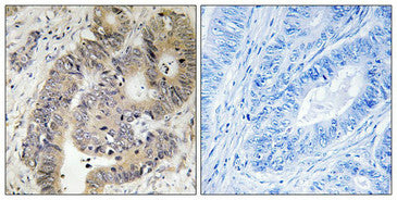 Immunohistochemical analysis of paraffin-embedded human colon carcinoma tissue using CAD (Phospho-Thr456) antibody (left)or the same antibody preincubated with blocking peptide (right).