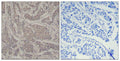 Immunohistochemical analysis of paraffin-embedded human breast carcinoma tissue using Smad3(Ab-425) Antibody(left) or the same antibody preincubated with blocking peptide(right).