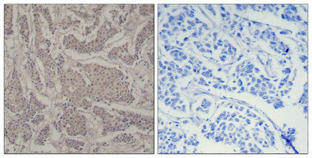 Immunohistochemical analysis of paraffin-embedded human breast carcinoma tissue using Smad3(Ab-425) Antibody(left) or the same antibody preincubated with blocking peptide(right).