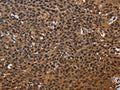 The image on the left is immunohistochemistry of paraffin-embedded Human cervical cancer tissue using CSB-PA794242(EXTL3 Antibody) at dilution 1/50, on the right is treated with fusion protein. (Original magnification: ×200)