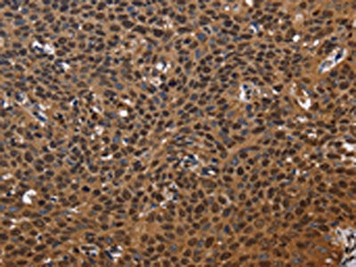The image on the left is immunohistochemistry of paraffin-embedded Human cervical cancer tissue using CSB-PA794242(EXTL3 Antibody) at dilution 1/50, on the right is treated with fusion protein. (Original magnification: ×200)