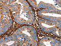 The image on the left is immunohistochemistry of paraffin-embedded Human cervical cancer tissue using CSB-PA794383(LGALS1 Antibody) at dilution 1/25, on the right is treated with fusion protein. (Original magnification: ×200)