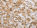 The image on the left is immunohistochemistry of paraffin-embedded Human thyroid cancer tissue using CSB-PA794556(DDIT4 Antibody) at dilution 1/20, on the right is treated with fusion protein. (Original magnification: ×200)